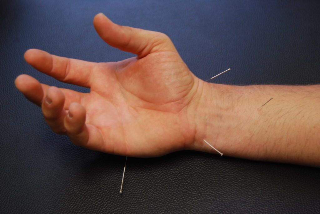 Acupuncture for Hand and Wrist Pain