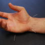 Acupuncture for Hand and Wrist Pain