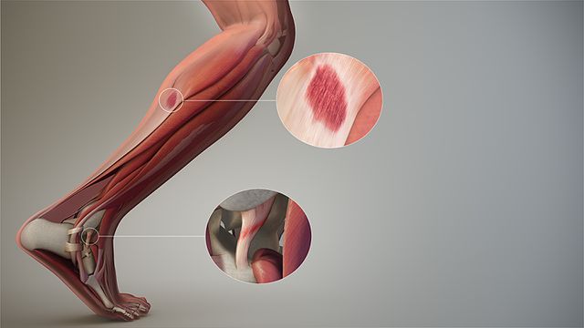 Soft Tissue Muscles that Affect Knee Pain in the Lower Leg