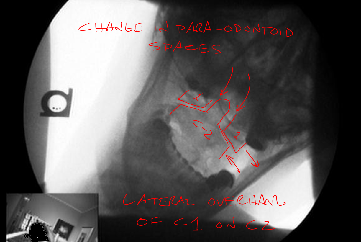 Abnormal Soft Tissue Injury from Car Wreck