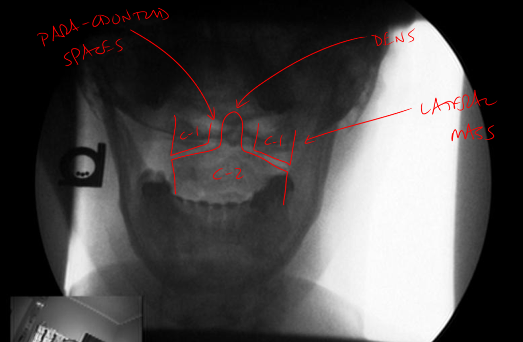 Normal Upper Cervical X-Ray