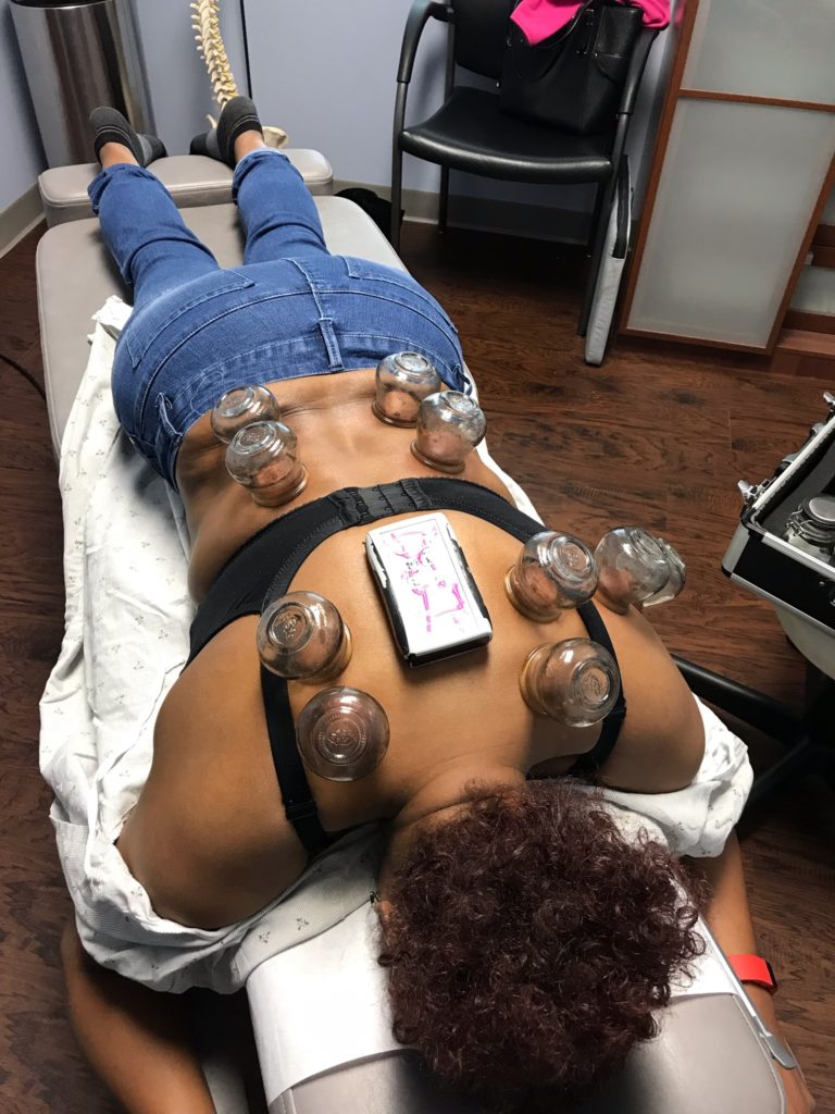 Cupping Therapy at Synergy Chiropractic of Houston