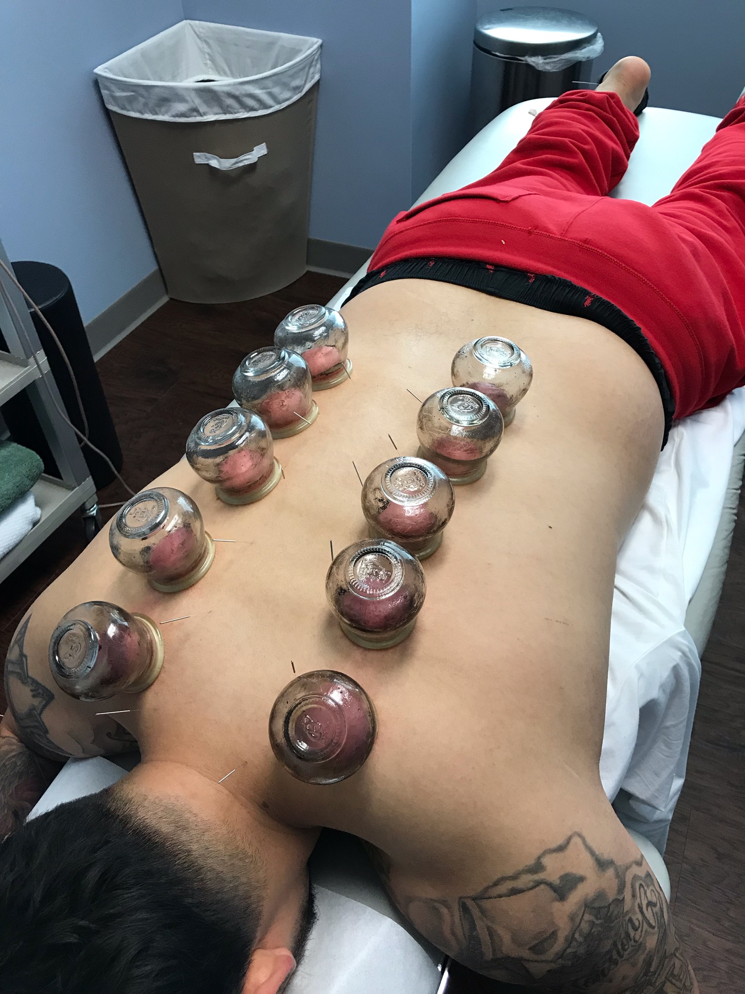 Cupping and Dry Needling Session at Synergy Chiropractic of Houston