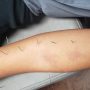 dry needling and arm pain at synergy chiropractic of houston