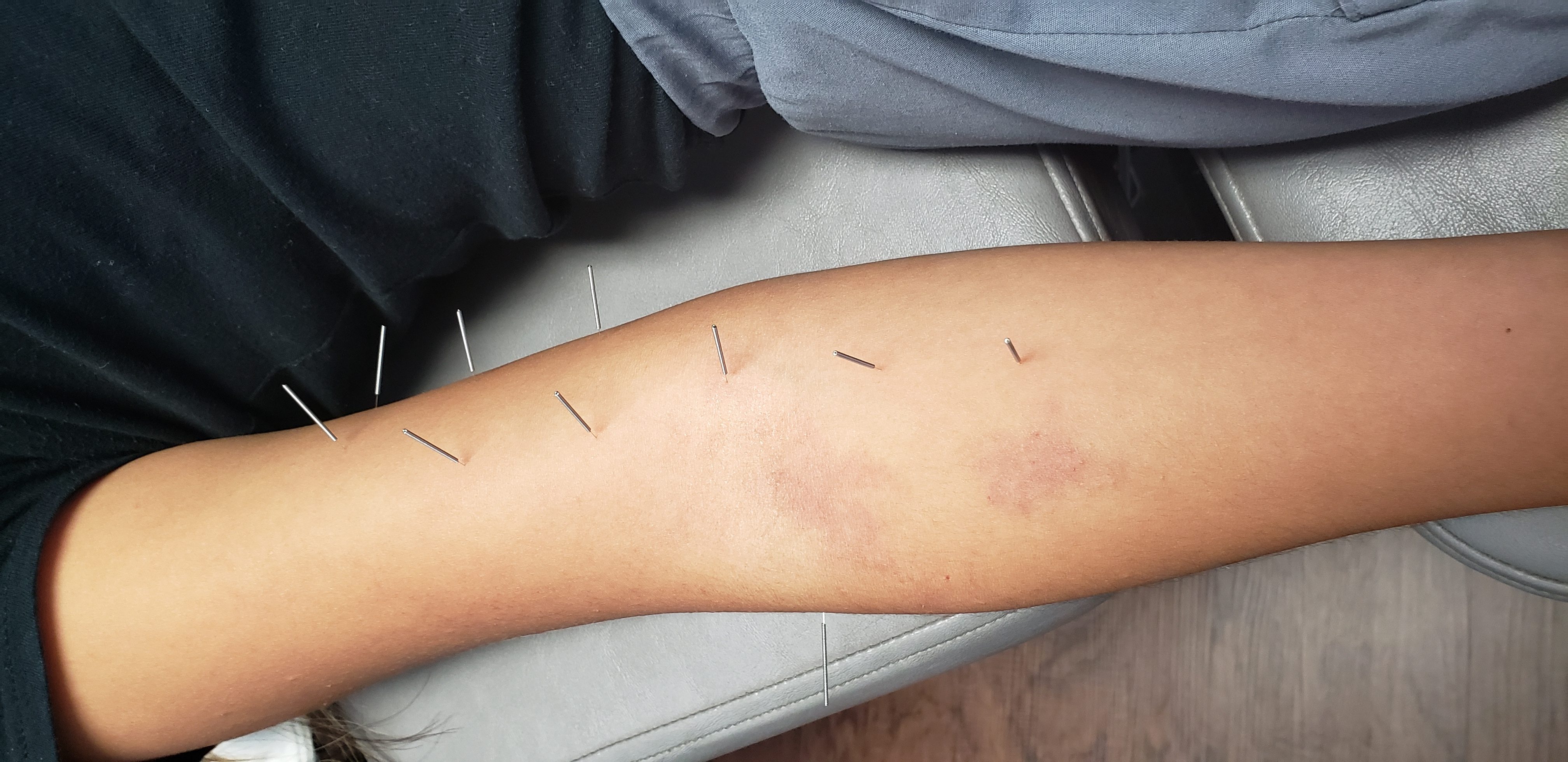 dry needling and arm pain at synergy chiropractic of houston