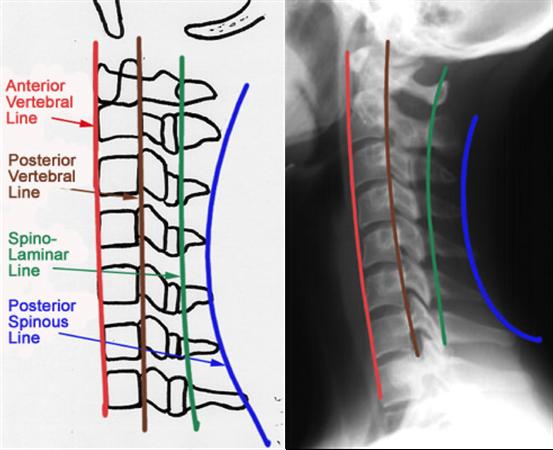 x-ray lines of the cervical spine