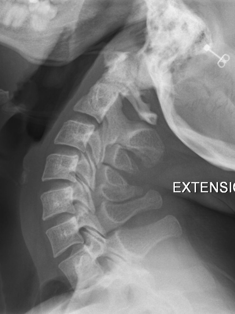 normal neck xray