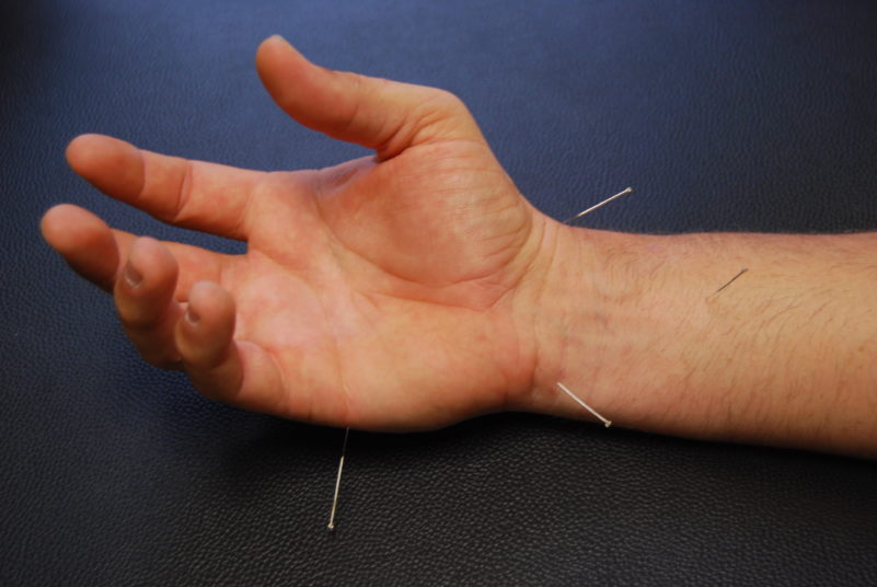 pain needling dry wrist acupuncture tunnel carpal hand syndrome points motor accident synergy trigger relief chiropractic houston muscle